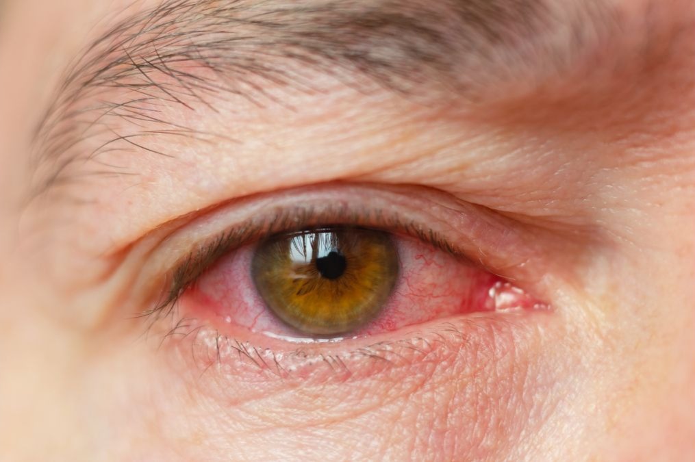 Bloodshot or Red Eyes